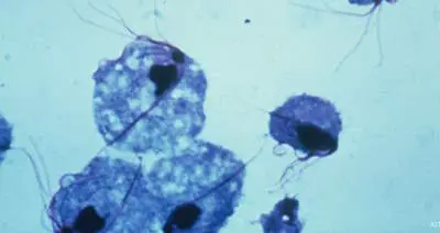 Распространенные половые инфекции - трихомоноз