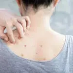 Прыщи на спине Прыщи на спине